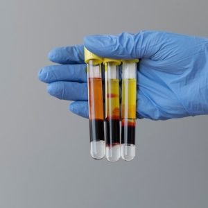 hand-with-glove-holding-vials-prp-treatment_23-2149404749 top 10 ivf center in patna